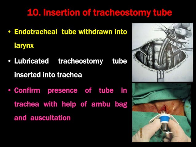 Tracheostomy: History, definition, indications, procedure ...