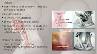 Vertical Dissection
