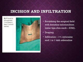 INCISION AND INFILTRATION
• Scrubbing the surgical field
with betadine solution(from
lower lips-chin-neck – ICS2).
• Draping
• Infiltration – 1% xylocaine
and 1 in 1 lakh adrenaline
 