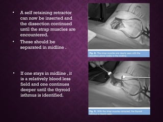 • A self retaining retractor
can now be inserted and
the dissection continued
until the strap muscles are
encountered.
• These should be
separated in midline .
• If one stays in midline , it
is a relatively blood less
field and one continues
deeper until the thyroid
isthmus is identified.
 