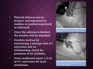 • Thyroid isthmus can be
incised and separated in
midline or pushed superiorly
or inferiorly
• Once the isthmus is divided
the trachea will be exposed.
• Confirm trachea by
introducing a syringe with 4%
xylocaine and on
withdrawing, check for
presence of air bubbles.
• Once confirmed inject 1-2 ml
of 4% xylocaine for local
anesthesia.
 