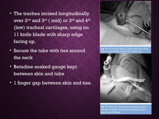 • The trachea incised longitudinally
over 2nd
and 3rd
( mid) or 3rd
and 4th
(low) tracheal cartilages, using no.
11 knife blade with sharp edge
facing up.
• Secure the tube with ties around
the neck
• Betadine soaked gauge kept
between skin and tube
• 1 finger gap between skin and ties.
 
