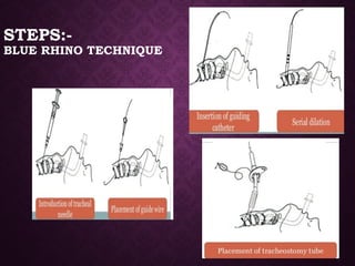 STEPS:-
BLUE RHINO TECHNIQUE
 