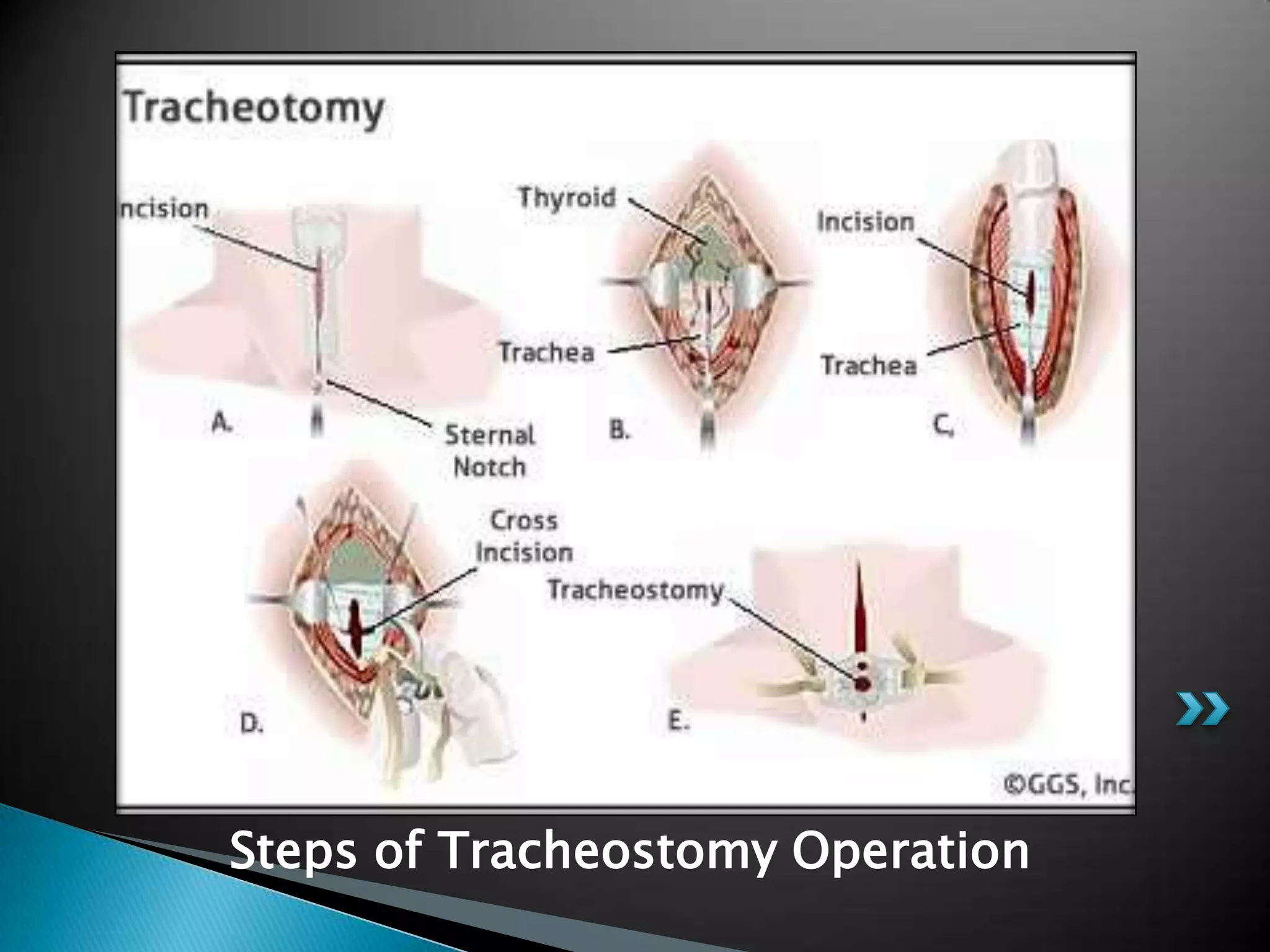 Tracheostomy a life saving emergency procedure | PPTX