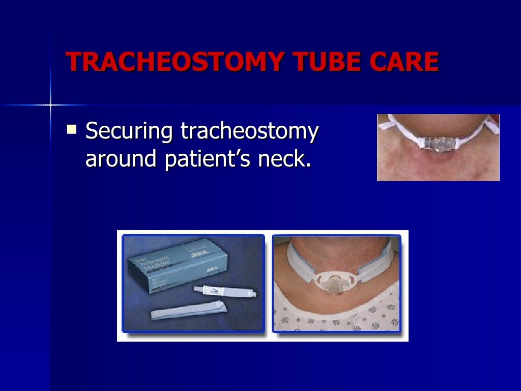 Tracheostomy