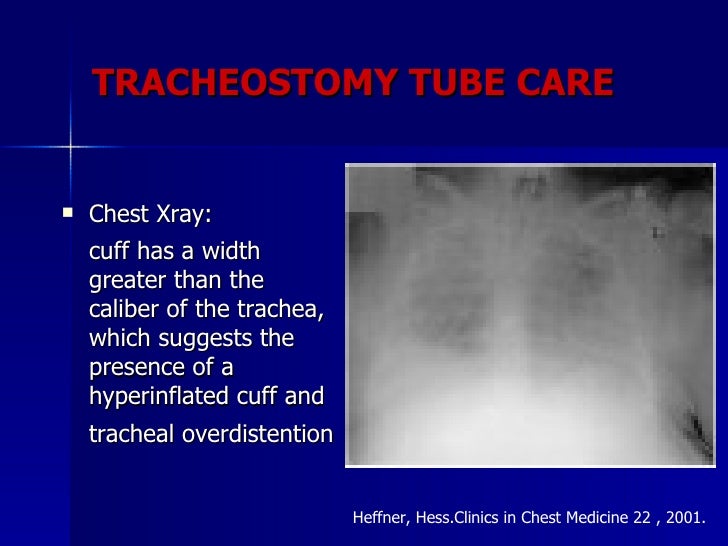 Tracheostomy