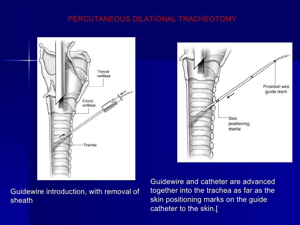 Tracheostomy