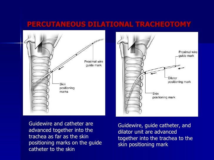 Tracheostomy