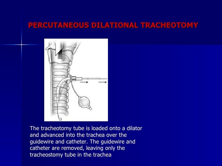 Tracheostomy