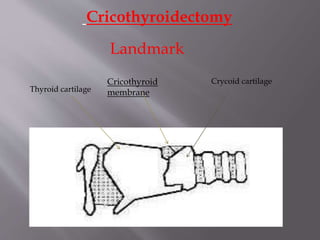 Transcricothyroid Injection Tracheostomy -INDICATIONS,CONTRAINDICATIONS,PROCEDURE,COMPLICATIONS | PPTX