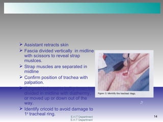 E.N.T DepartmentE.N.T Department
14
E.N.T DepartmentE.N.T Department
14
 Assistant retracts skin
 Fascia divided vertically in midline
with scissors to reveal strap
muslces.
 Strap muscles are separated in
midline
 Confirm position of trachea with
palpation.
 If thyroid isthmus is bulky it can be
divided in midline with diathermy,
or moved up or down out of the
way.
 Identify cricoid to avoid damage to
1st
tracheal ring.
 