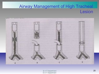 E.N.T DepartmentE.N.T Department
20
E.N.T DepartmentE.N.T Department
20
Airway Management of High Tracheal
Lesion
 