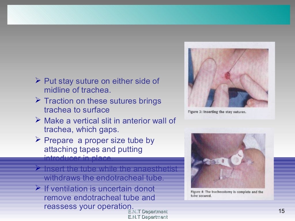Tracheostomy surgical procedure