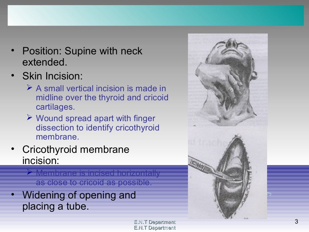 Tracheostomy surgical procedure
