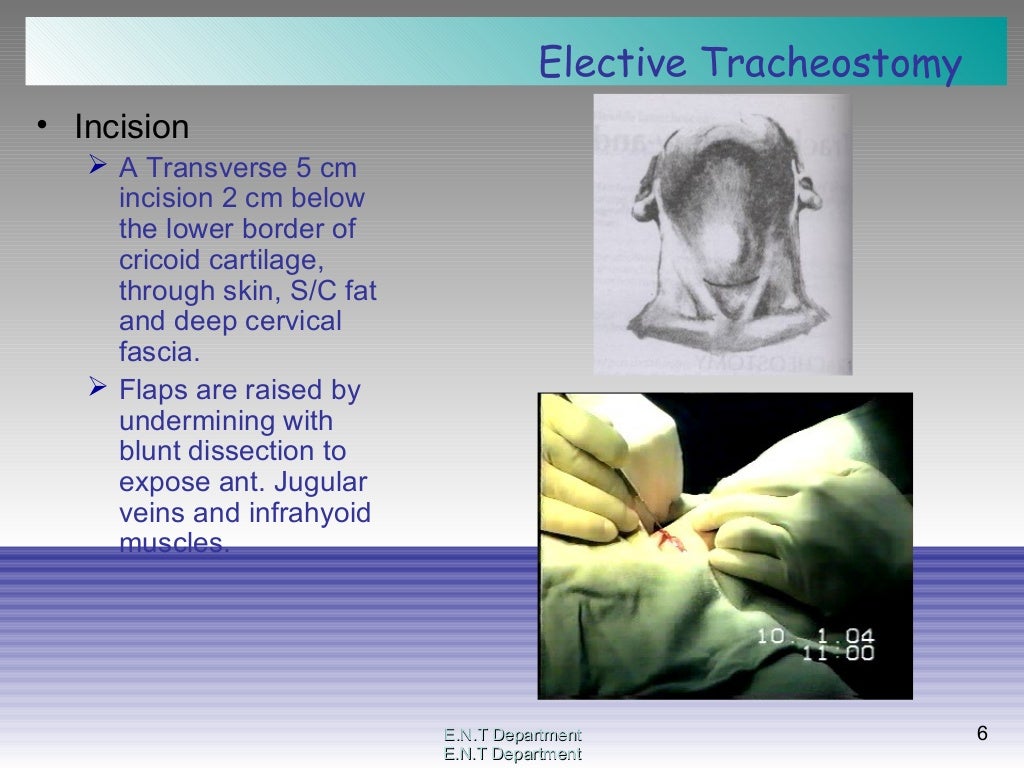 Tracheostomy surgical procedure