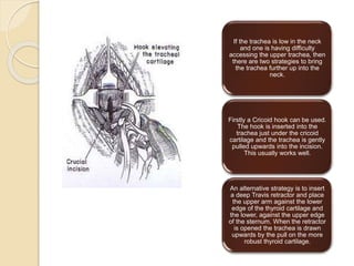 If the trachea is low in the neck
and one is having difficulty
accessing the upper trachea, then
there are two strategies to bring
the trachea further up into the
neck.
Firstly a Cricoid hook can be used.
The hook is inserted into the
trachea just under the cricoid
cartilage and the trachea is gently
pulled upwards into the incision.
This usually works well.
An alternative strategy is to insert
a deep Travis retractor and place
the upper arm against the lower
edge of the thyroid cartilage and
the lower, against the upper edge
of the sternum. When the retractor
is opened the trachea is drawn
upwards by the pull on the more
robust thyroid cartilage.
 