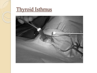 Thyroid Isthmus
 