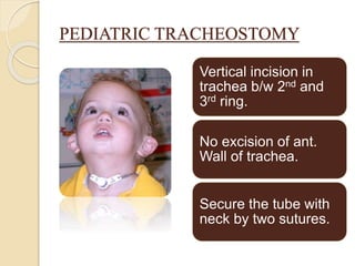 PEDIATRIC TRACHEOSTOMY
Vertical incision in
trachea b/w 2nd and
3rd ring.
No excision of ant.
Wall of trachea.
Secure the tube with
neck by two sutures.
 