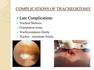 COMPLICATIONS OF TRACHEOSTOMY
 Late Complications
 Tracheal Stenosis
 Granulation tissue
 Tracheocutaneus fistula
 Tracheo - inominate fistula
 