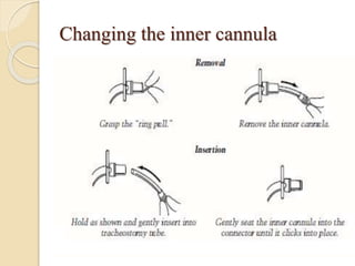 Changing the inner cannula
 