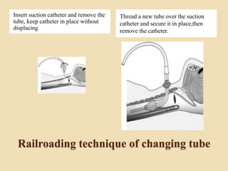Railroading technique of changing tube
Insert suction catheter and remove the
tube, keep catheter in place without
displacing
Thread a new tube over the suction
catheter and secure it in place,then
remove the catheter.
 
