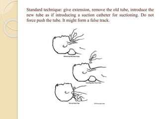 Standard technique: give extension, remove the old tube, introduce the
new tube as if introducing a suction catheter for suctioning. Do not
force push the tube. It might form a false track.
 