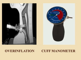 OVERINFLATION CUFF MANOMETER
 