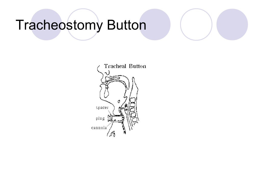 Tracheostomy and its post op care last