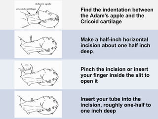 Tracheostomy | PPT