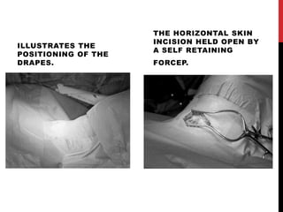 ILLUSTRATES THE
POSITIONING OF THE
DRAPES.
THE HORIZONTAL SKIN
INCISION HELD OPEN BY
A SELF RETAINING
FORCEP.
 