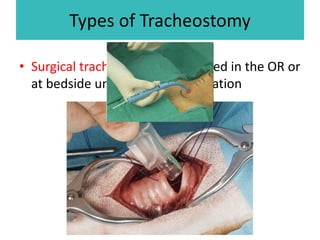 Types of Tracheostomy
• Surgical tracheostomy: performed in the OR or
at bedside under moderate sedation
• Percutaneous dilatational tracheostomy is
done at the patient’s bedside, usually in the
ICU setting. contraindicated in anatomical
irregularities or coagulation problems.
 