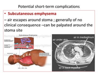 • Subcutaneous emphysema
– air escapes around stoma ; generally of no
clinical consequence –can be palpated around the
stoma site
Potential short-term complications
 