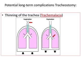 • Thinning of the trachea (Trachemalacia)
Potential long-term complications Tracheostomy:
 