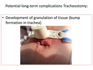 • Development of granulation of tissue (bump
formation in trachea)
Potential long-term complications Tracheostomy:
 