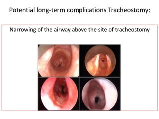 Narrowing of the airway above the site of tracheostomy
Potential long-term complications Tracheostomy:
 