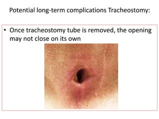• Once tracheostomy tube is removed, the opening
may not close on its own
Potential long-term complications Tracheostomy:
 