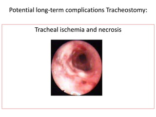 Tracheal ischemia and necrosis
Potential long-term complications Tracheostomy:
 