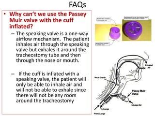 • Why can’t we use the Passey
Muir valve with the cuff
inflated?
– The speaking valve is a one-way
airflow mechanism. The patient
inhales air through the speaking
valve but exhales it around the
tracheostomy tube and then
through the nose or mouth.
– If the cuff is inflated with a
speaking valve, the patient will
only be able to inhale air and
will not be able to exhale since
there will not be any room
around the tracheostomy
FAQs
 