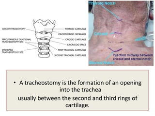 • A tracheostomy is the formation of an opening
into the trachea
usually between the second and third rings of
cartilage.
 