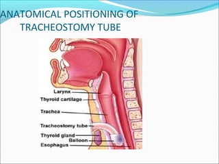ANATOMICAL POSITIONING OF
TRACHEOSTOMY TUBE
 