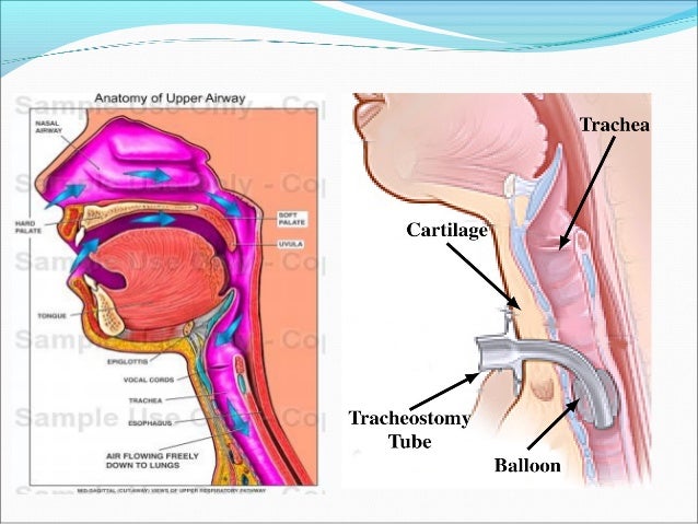 tracheostomy anatomy under fontanacountryinn com tracheostomy anatomy