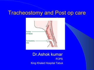 Tracheostomy and Post op careTracheostomy and Post op care
Dr.Ashok kumar
FCPS
King Khaled Hospital Tabuk
 