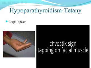 Hypoparathyroidism-Tetany
Carpal spasm
 