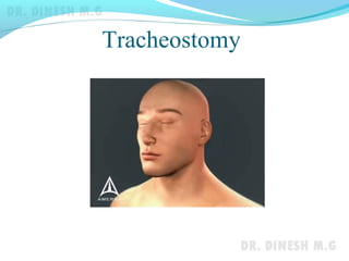 Tracheostomy
 