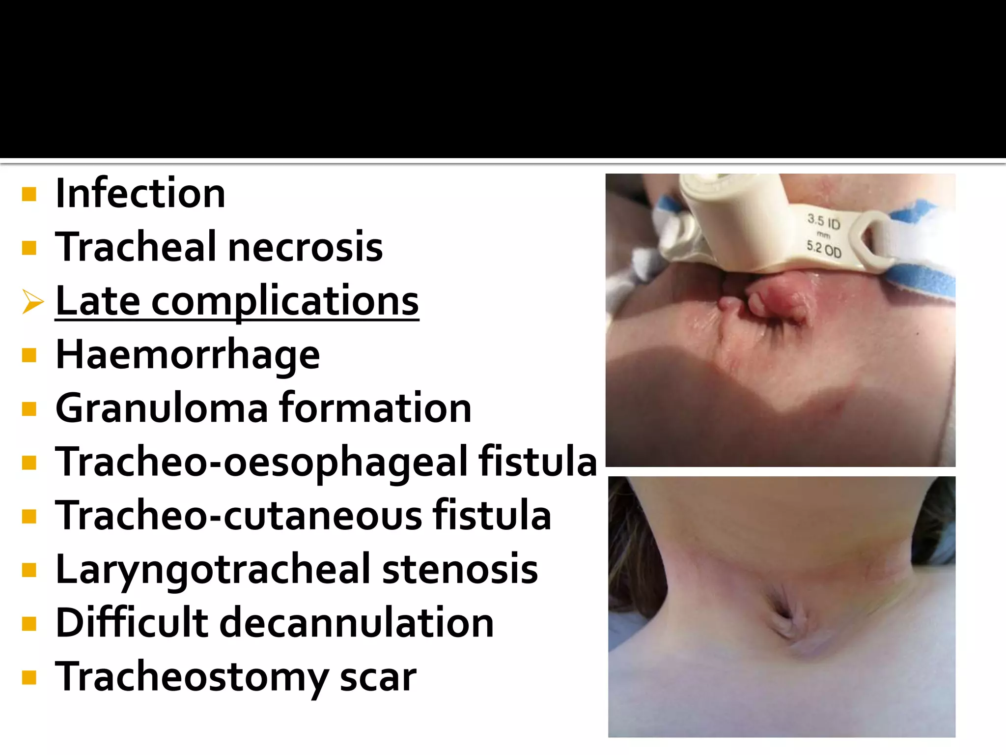  Infection
 Tracheal necrosis
 Late complications
 Haemorrhage
 Granuloma formation
 Tracheo-oesophageal fistula
 Tracheo-cutaneous fistula
 Laryngotracheal stenosis
 Difficult decannulation
 Tracheostomy scar
 