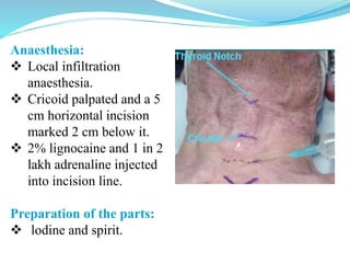 Anaesthesia:
 Local infiltration
anaesthesia.
 Cricoid palpated and a 5
cm horizontal incision
marked 2 cm below it.
 2% lignocaine and 1 in 2
lakh adrenaline injected
into incision line.
Preparation of the parts:
 lodine and spirit.
 