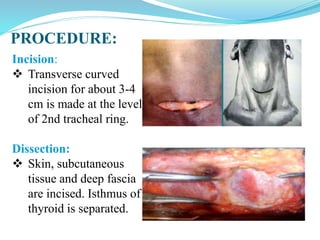 PROCEDURE:
Incision:
 Transverse curved
incision for about 3-4
cm is made at the level
of 2nd tracheal ring.
Dissection:
 Skin, subcutaneous
tissue and deep fascia
are incised. Isthmus of
thyroid is separated.
 