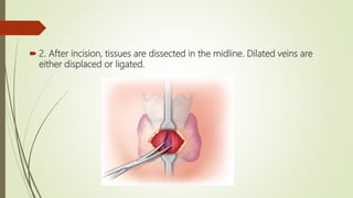  2. After incision, tissues are dissected in the midline. Dilated veins are
either displaced or ligated.
 