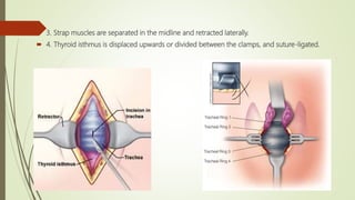  3. Strap muscles are separated in the midline and retracted laterally.
 4. Thyroid isthmus is displaced upwards or divided between the clamps, and suture-ligated.
 