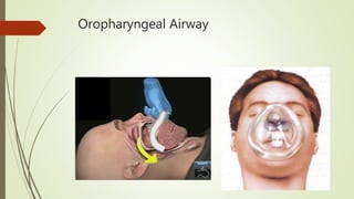 Oropharyngeal Airway
 
